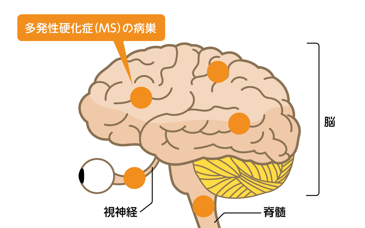 多発性硬化症ができる場所